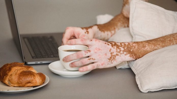 Entenda como a alimentação influencia no vitiligo