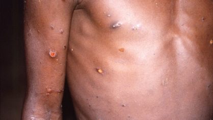 Varíola dos macacos pode ser mais perigosa que a varíola humana?